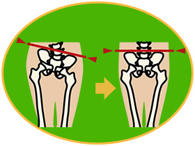 骨盤の歪みイメージ
